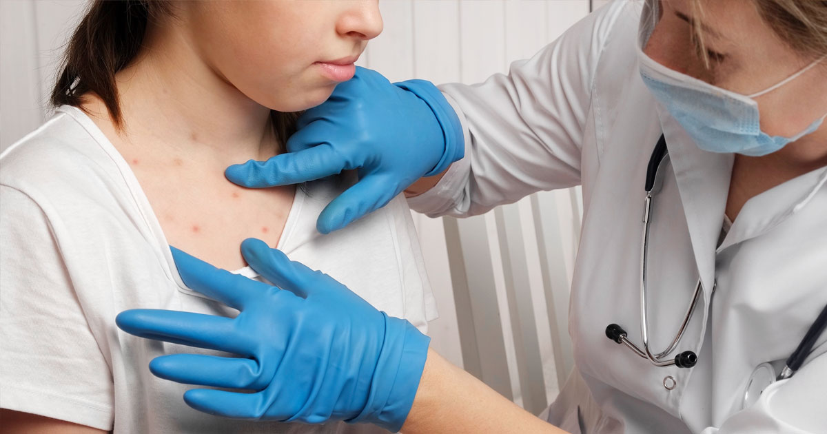 Measles